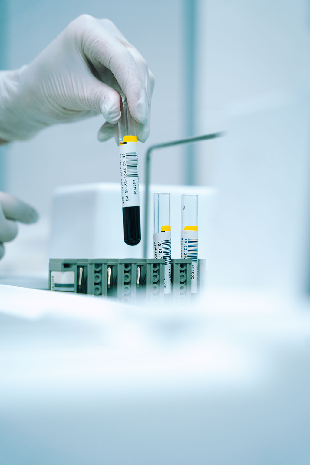 Imagen: El análisis de microARN en sangre podría predecir la supervivencia general del NSCLC avanzado (Fotografía cortesía de Unsplash) Imagen: El análisis de microARN en sangre podría predecir la supervivencia general del NSCLC avanzado (Fotografía cortesía de Unsplash)