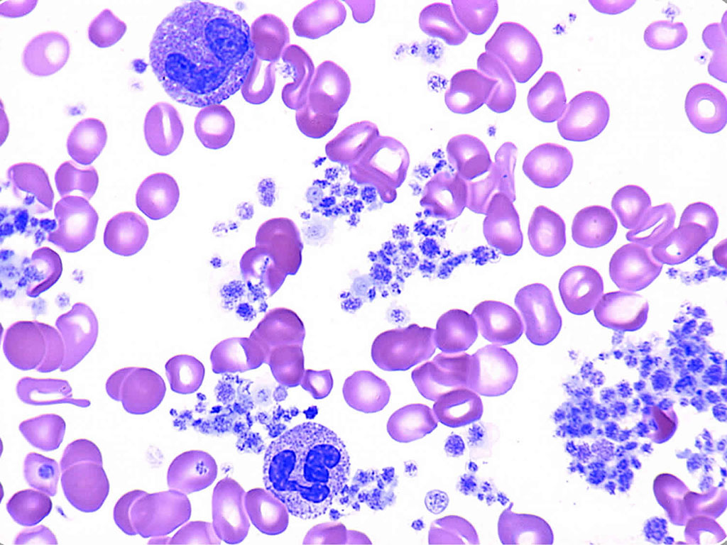 Imagen: Frotis de sangre de plaquetas que aumentaron significativamente en la sífilis primaria y secundaria (Fotografía cortesía de HealthJade)