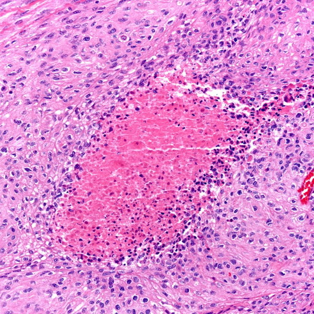Imagen: Fotomicrografía de la histología de la patofisiología del meningioma (Fotografía cortesía del Dr. Dharam Ramnani) Imagen: Fotomicrografía de la histología de la patofisiología del meningioma (Fotografía cortesía del Dr. Dharam Ramnani)