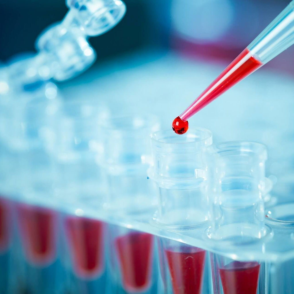 Imagen: Biomarcador tumoral basado en la sangre puede predecir el beneficio de inmunoterapia para el cáncer de PCNP (Fotografía cortesía de la Universidad Northwestern) Imagen: Biomarcador tumoral basado en la sangre puede predecir el beneficio de inmunoterapia para el cáncer de PCNP (Fotografía cortesía de la Universidad Northwestern)