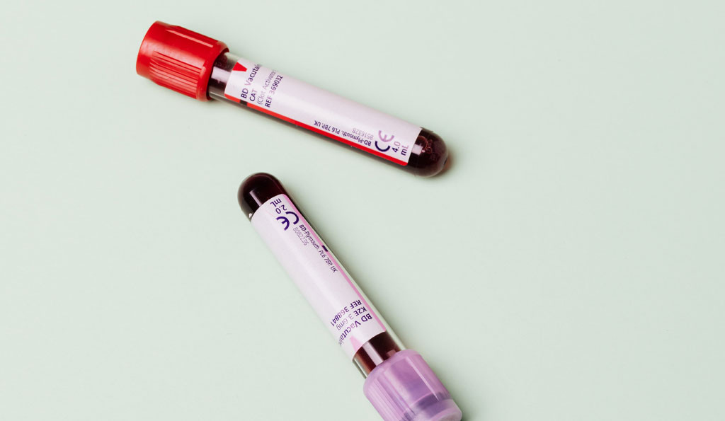 Imagen: El nuevo análisis de sangre puede ayudar a los médicos a diagnosticar tuberculosis y monitorear el tratamiento (Fotografía cortesía de Pexels) Imagen: El nuevo análisis de sangre puede ayudar a los médicos a diagnosticar tuberculosis y monitorear el tratamiento (Fotografía cortesía de Pexels)