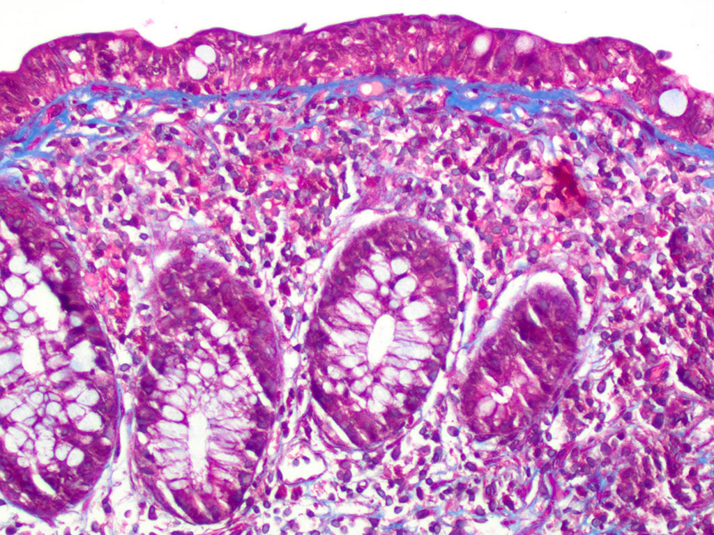 Imagen: Biopsia colónica con características de colitis colágena. La tinción tricrómica resalta el colágeno subepitelial irregular con atrapamiento de capilares y células inflamatorias (Fotografía cortesía de Catherine E. Hagen, MD)
