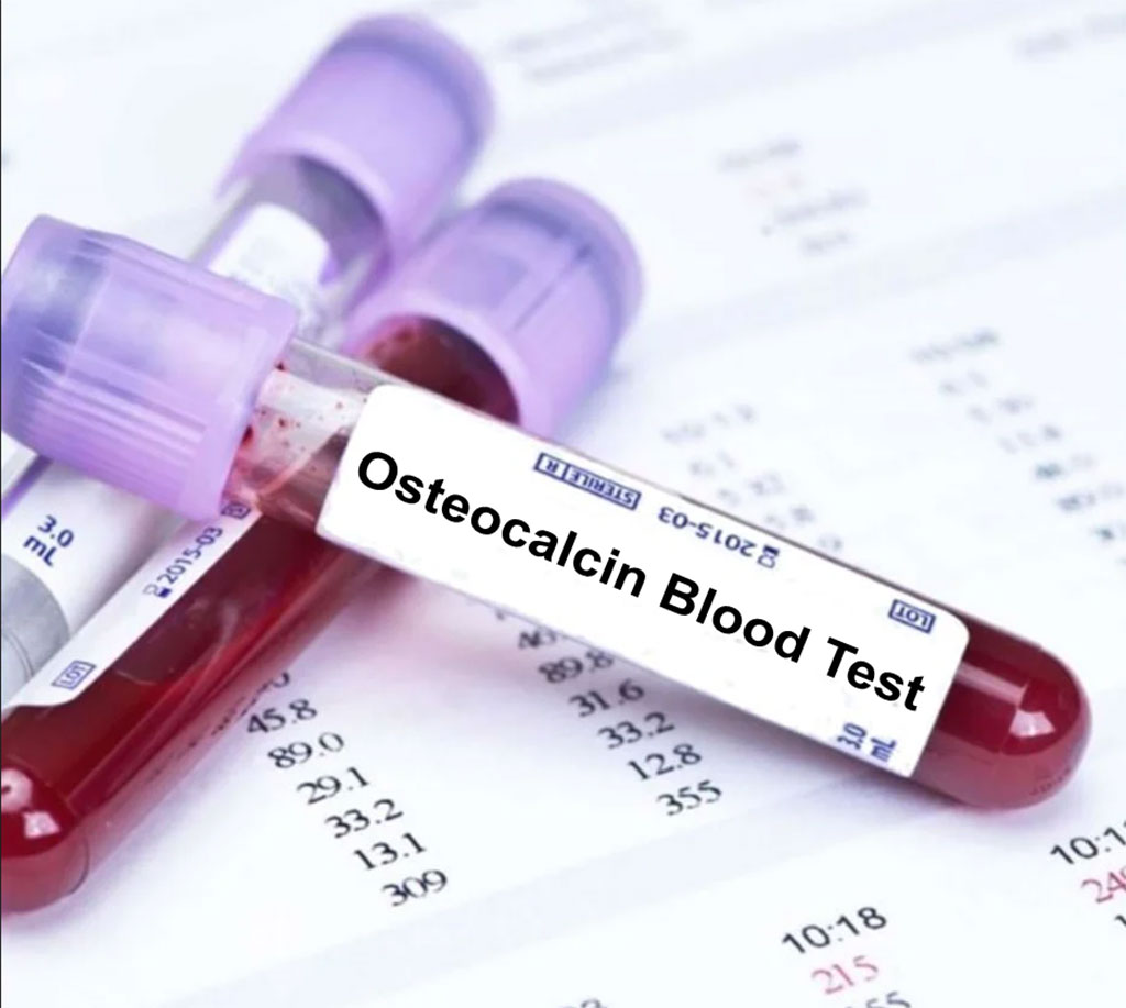 Imagen: Los marcadores de recambio óseo, incluida la osteocalcina subcarboxilada, están asociados con el riesgo de mortalidad en hombres mayores (Fotografía cortesía de Blood Tests en Londres)