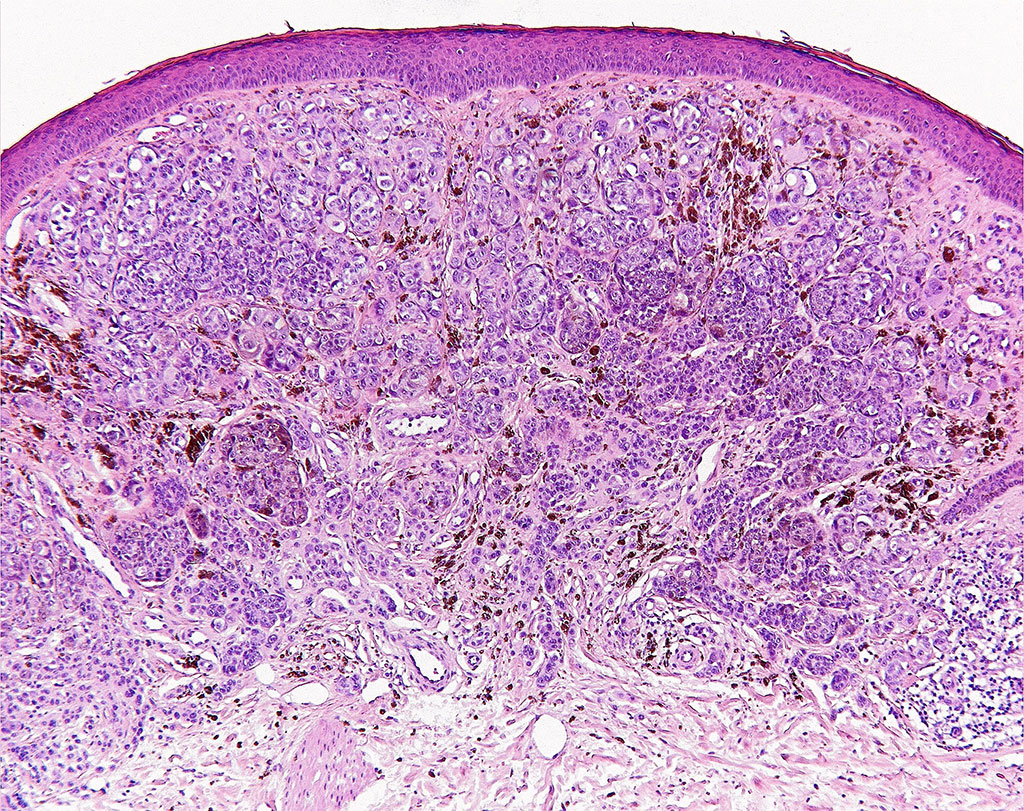 Imagen: Microfotografía de la histopatología del melanoma maligno (Fotografía cortesía de DiseaeseShows) Imagen: Microfotografía de la histopatología del melanoma maligno (Fotografía cortesía de DiseaeseShows)