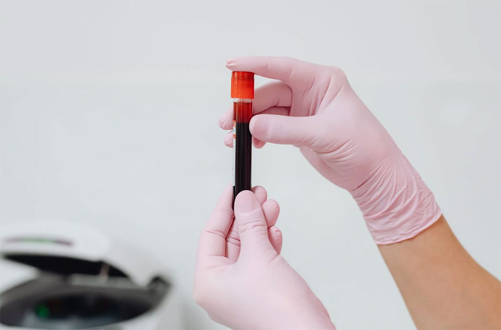 Imagen: Los científicos han desbloqueado el potencial para un análisis de sangre de cáncer de pulmón de células pequeñas (Fotografía cortesía de Pexels) Imagen: Los científicos han desbloqueado el potencial para un análisis de sangre de cáncer de pulmón de células pequeñas (Fotografía cortesía de Pexels)