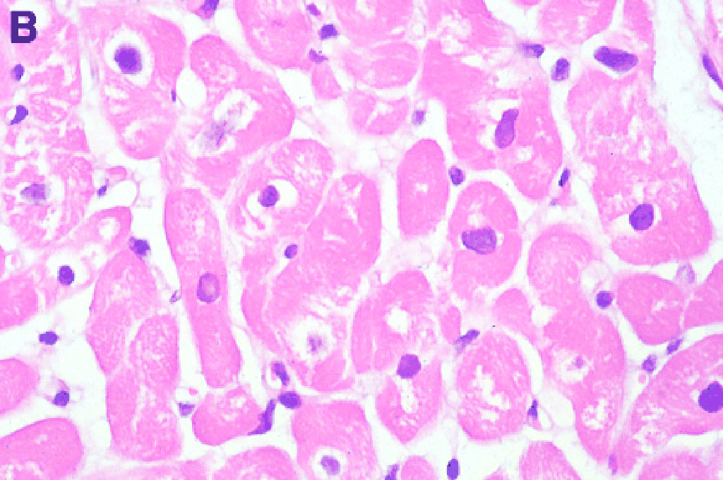 Imagen: Histopatología de una biopsia de un paciente con cardiomiopatía dilatada. Los miocitos han perdido miofibrillas y han aparecido espacios vacíos dentro del citoplasma (Fotografía cortesía del profesor Michael John Davies, MD, FRCPath) Imagen: Histopatología de una biopsia de un paciente con cardiomiopatía dilatada. Los miocitos han perdido miofibrillas y han aparecido espacios vacíos dentro del citoplasma (Fotografía cortesía del profesor Michael John Davies, MD, FRCPath)