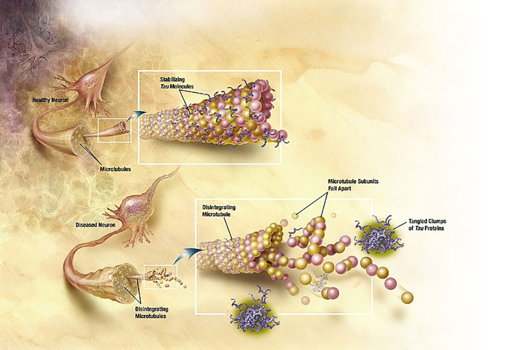 Imagen: En la enfermedad de Alzheimer, los cambios en la proteína tau conducen a la desintegración de los microtúbulos en las células cerebrales (Fotografía cortesía de Wikimedia Commons)