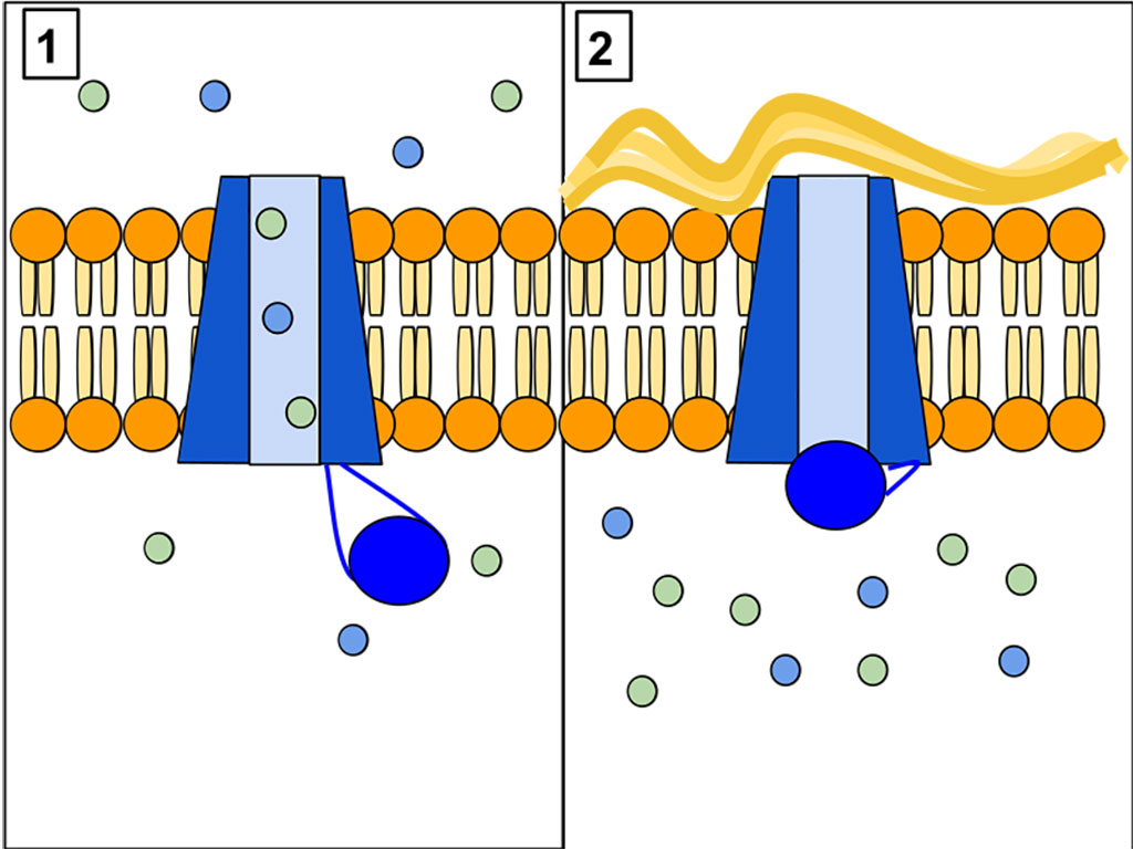 Imagen: La proteína CFTR es una proteína de canal que controla el flujo de H2O e iones CI dentro y fuera de las células dentro de los pulmones. Cuando la proteína CFTR funciona correctamente, como se muestra en el panel 1, los iones fluyen libremente dentro y fuera de las células. Sin embargo, cuando la proteína CFTR no funciona adecuadamente, como en el panel 2, estos iones no pueden fluir hacia afuera de la célula debido a un canal bloqueado. Esto causa fibrosis quística, caracterizada por la acumulación de moco grueso en los pulmones (Fotografía cortesía de Wikimedia Commons)