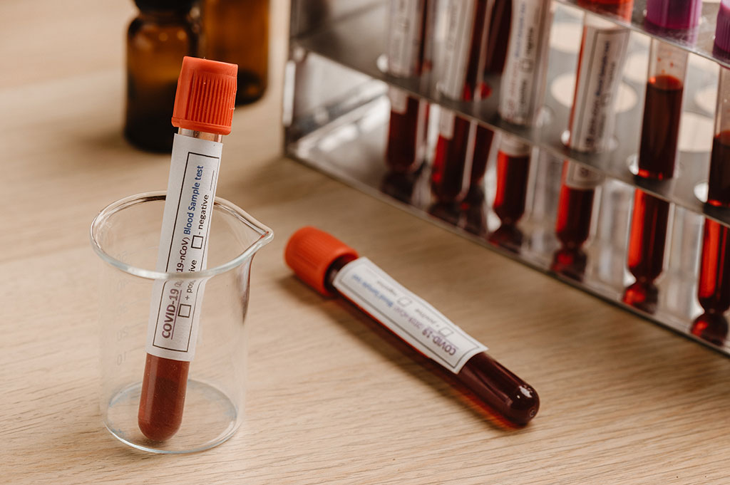 Imagen: Un análisis de sangre puede detectar un nuevo marcador de neurodegeneración de la enfermedad de Alzheimer (Fotografía cortesía de Pexels) Imagen: Un análisis de sangre puede detectar un nuevo marcador de neurodegeneración de la enfermedad de Alzheimer (Fotografía cortesía de Pexels)