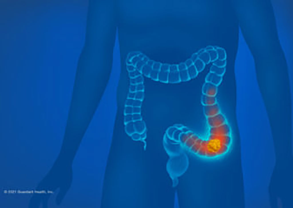 Imagen: La prueba demostró una sensibilidad del 83 % para la detección de cáncer colorrectal con una especificidad del 90 % (Fotografía cortesía de Guardant Health) Imagen: La prueba demostró una sensibilidad del 83 % para la detección de cáncer colorrectal con una especificidad del 90 % (Fotografía cortesía de Guardant Health)