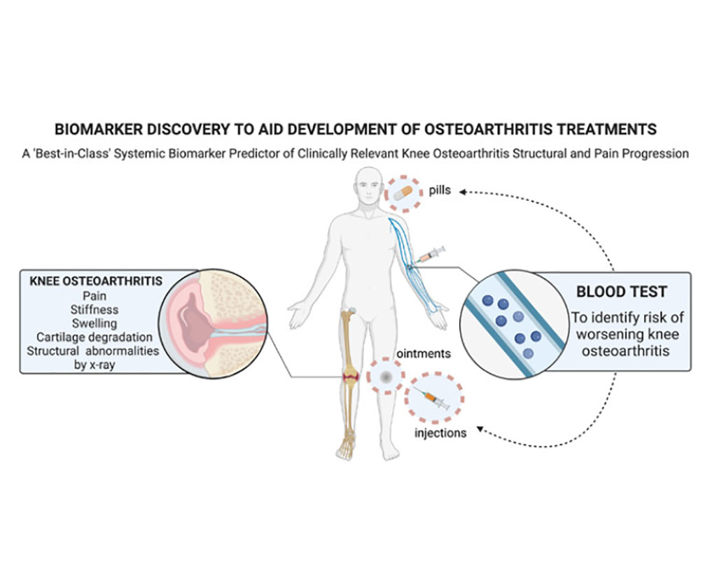Imagen: El descubrimiento de biomarcadores podría ayudar al desarrollo de los tratamientos para la osteoartritis (Fotografía cortesía de la Universidad de Duke)