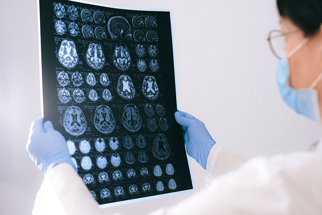 Imagen: Los investigadores han identificado un nuevo biomarcador de la enfermedad de Alzheimer en etapa temprana (Fotografía cortesía de Pexels) Imagen: Los investigadores han identificado un nuevo biomarcador de la enfermedad de Alzheimer en etapa temprana (Fotografía cortesía de Pexels)
