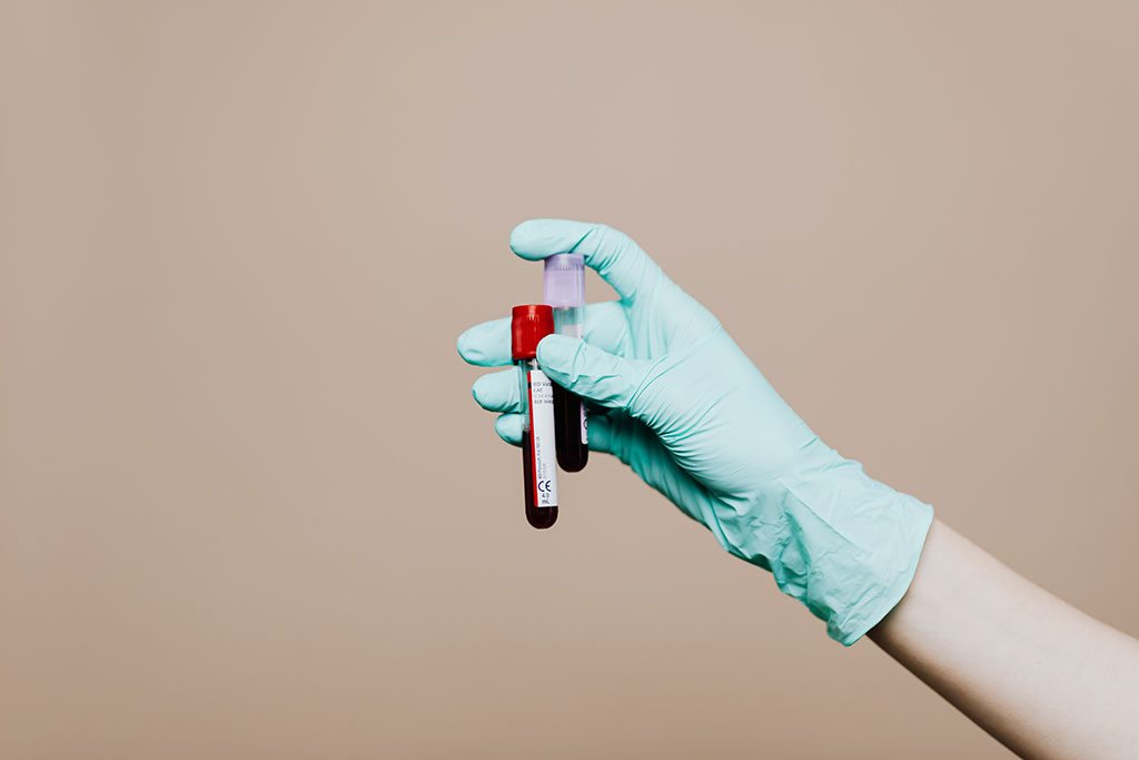 Imagen: Los biomarcadores basados en sangre para la enfermedad de Alzheimer podrían simplificar el diagnóstico y reducir los costos (Fotografía cortesía de Pexels) Imagen: Los biomarcadores basados en sangre para la enfermedad de Alzheimer podrían simplificar el diagnóstico y reducir los costos (Fotografía cortesía de Pexels)