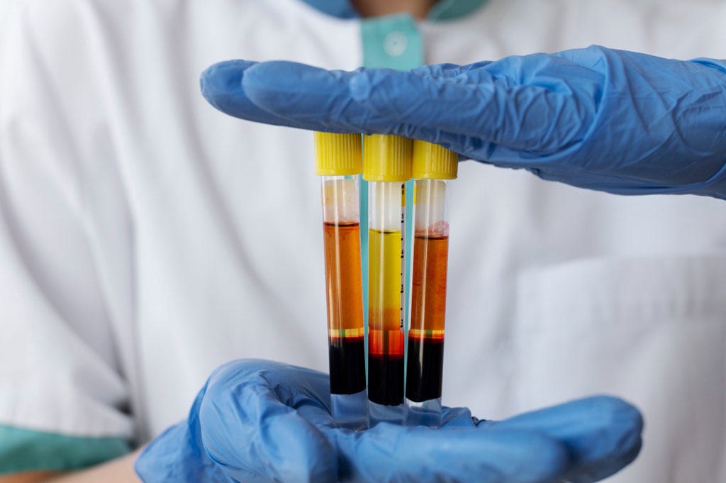 Imagen: Una prueba puede detectar la acumulación de depósitos de proteínas anormales relacionados con la enfermedad de Parkinson en el líquido cefalorraquídeo (Fotografía cortesía de Freepik) Imagen: Una prueba puede detectar la acumulación de depósitos de proteínas anormales relacionados con la enfermedad de Parkinson en el líquido cefalorraquídeo (Fotografía cortesía de Freepik)