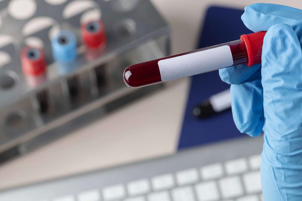 Imagen: Las pruebas basadas en biomarcadores de sangre pueden ser la solución en la lucha contra la tuberculosis (Fotografía cortesía de Freepik)