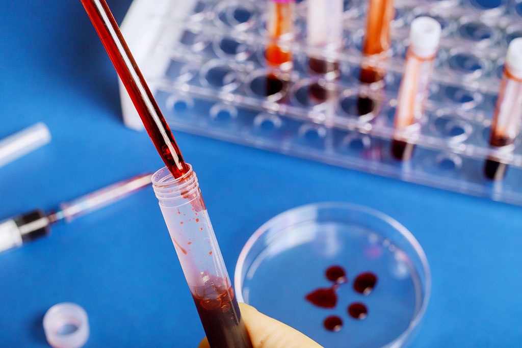 Imagen: Un nuevo análisis de sangre para ARN no codificante mejora la detección del cáncer (Fotografía cortesía de 123RF)