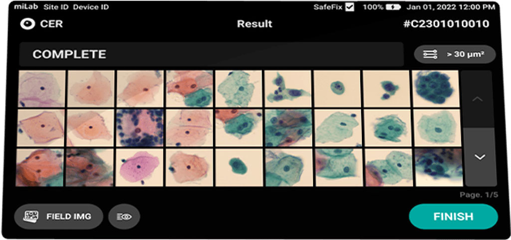 Imagen: El miLab Cartridge CER utiliza la citología de cuello uterino como método de detección (Fotografía cortesía de Noul)