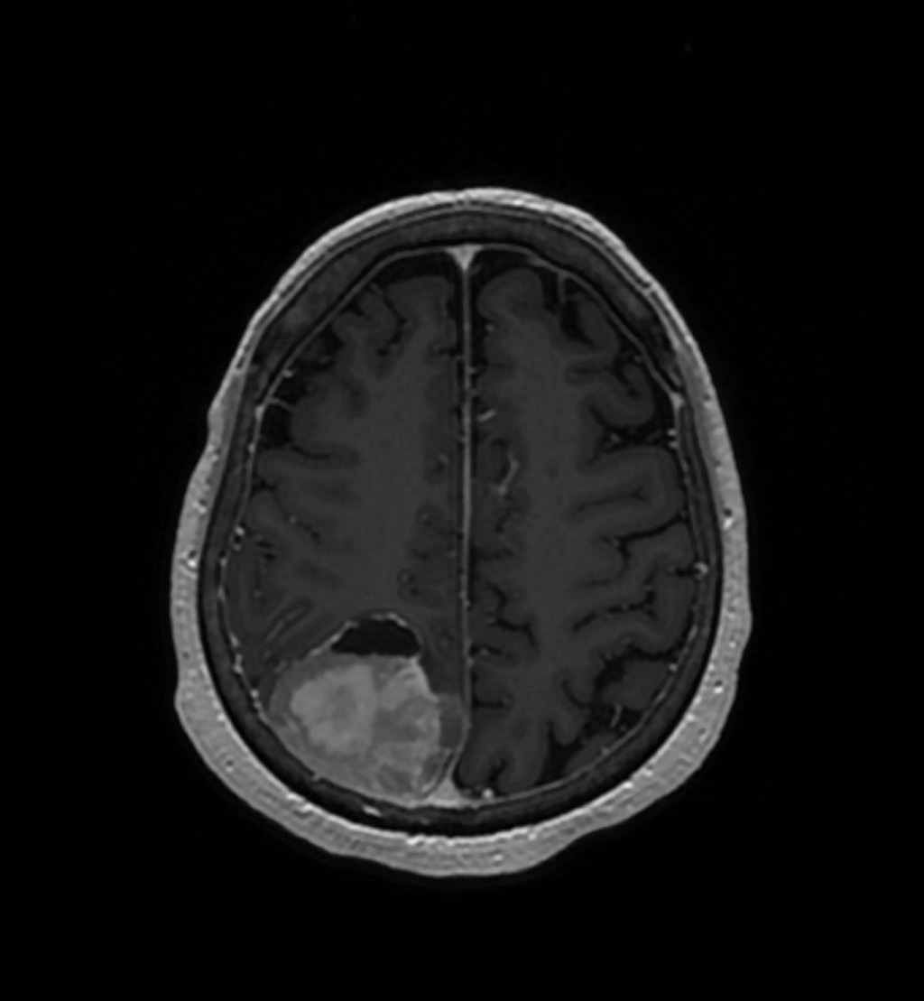 Imagen: La nueva prueba podría cambiar el tratamiento para 1 de cada 3 pacientes con meningioma (Fotografía cortesía de UCSF)