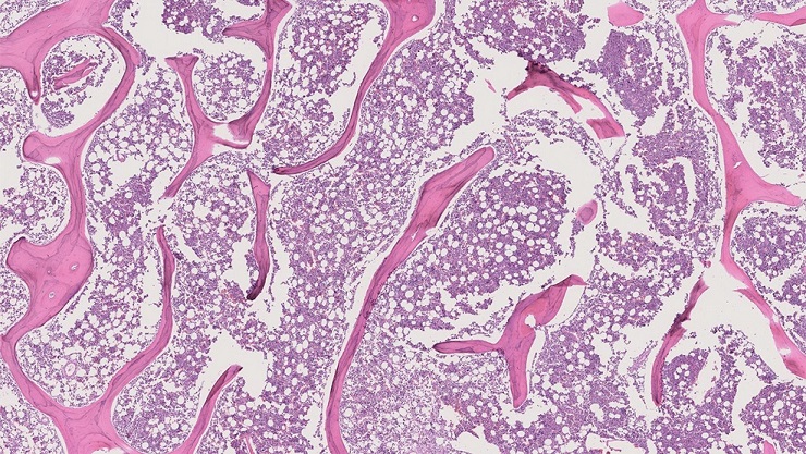 Imagen: Una imagen microscópica del osteosarcoma intramedular (Fotografía cortesía de Johns Hopkins Medicine)