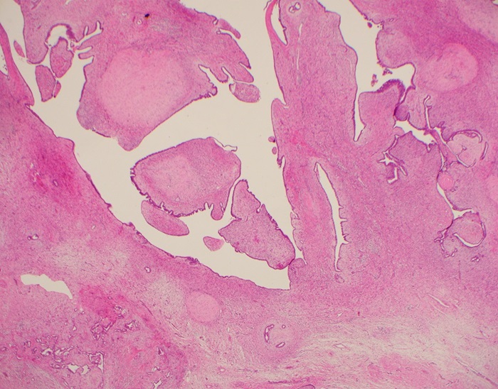 Imagen: Los científicos han descubierto biomarcadores para tumores de mama raros (Fotografía cortesía del Instituto Garvan)