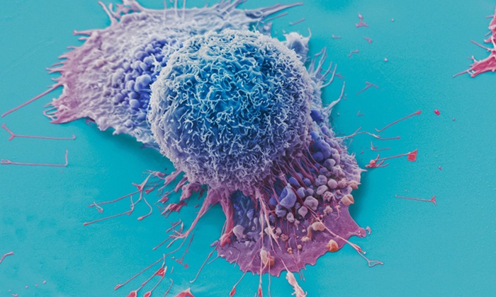 Imagen: Una micrografía de escaneo electrónico de color falso que muestra células de cáncer de pulmón cultivadas en cultivo (foto cortesía de Anne Weston)