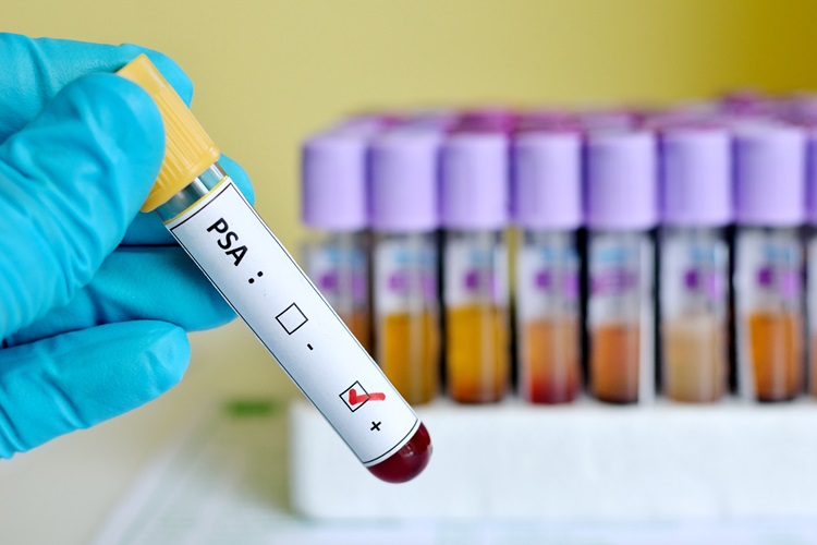 Imagen: La prueba de cáncer de próstata Stockholm3 produce resultados significativamente mejores que el estándar actual de PSA (cortesía de la foto de 123RF) Imagen: La prueba de cáncer de próstata Stockholm3 produce resultados significativamente mejores que el estándar actual de PSA (cortesía de la foto de 123RF)