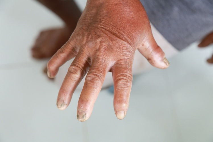 Imagen: un grupo de proteínas involucradas en la señalización celular se puede usar como biomarcador sanguíneo para pacientes con esclerosis sistémica cutánea difusa (foto cortesía de Shutterstock) Imagen: un grupo de proteínas involucradas en la señalización celular se puede usar como biomarcador sanguíneo para pacientes con esclerosis sistémica cutánea difusa (foto cortesía de Shutterstock)