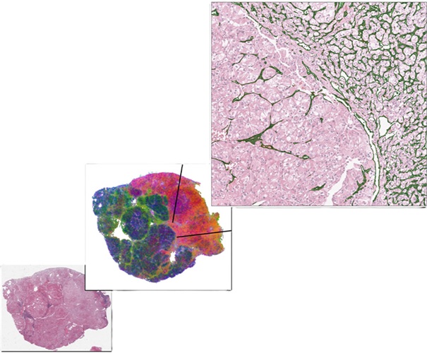 Imagen: una imagen de diapositiva histopatológica típica del tejido de cáncer de riñón (izquierda) tiene una heterogeneidad intra-deslizante significativa (foto cortesía del Centro Médico UT Southwestern) Imagen: una imagen de diapositiva histopatológica típica del tejido de cáncer de riñón (izquierda) tiene una heterogeneidad intra-deslizante significativa (foto cortesía del Centro Médico UT Southwestern)