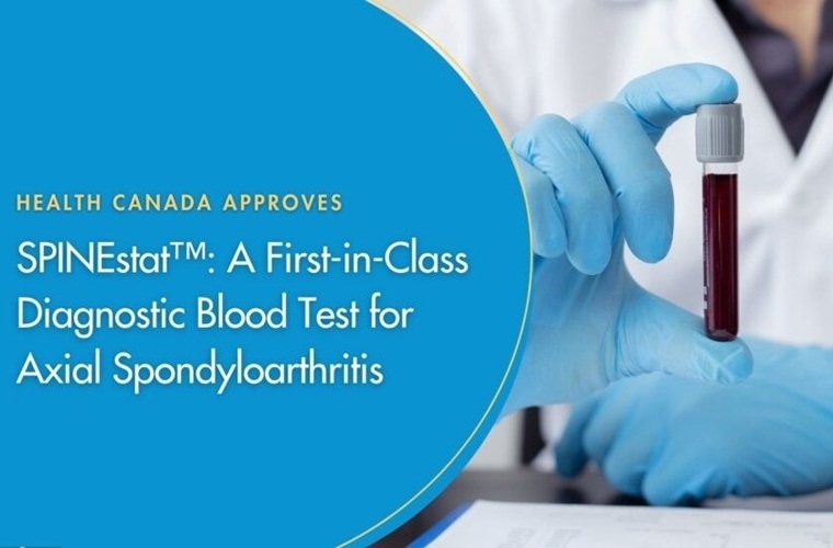Imagen: Health Canada ha aprobado SPINEstat, una prueba de sangre diagnóstica de primera clase para la espondiloartritis axial, como un dispositivo médico de clase II (foto cortesía de Augurex) Imagen: Health Canada ha aprobado SPINEstat, una prueba de sangre diagnóstica de primera clase para la espondiloartritis axial, como un dispositivo médico de clase II (foto cortesía de Augurex)
