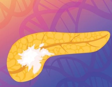 Imagen: el ADN tumoral pancreático en circulación puede usarse mediante un análisis de sangre con IA nuevo para determinar la respuesta a la terapia contra el cáncer (foto cortesía de Carolyn Hruban) Imagen: el ADN tumoral pancreático en circulación puede usarse mediante un análisis de sangre con IA nuevo para determinar la respuesta a la terapia contra el cáncer (foto cortesía de Carolyn Hruban)