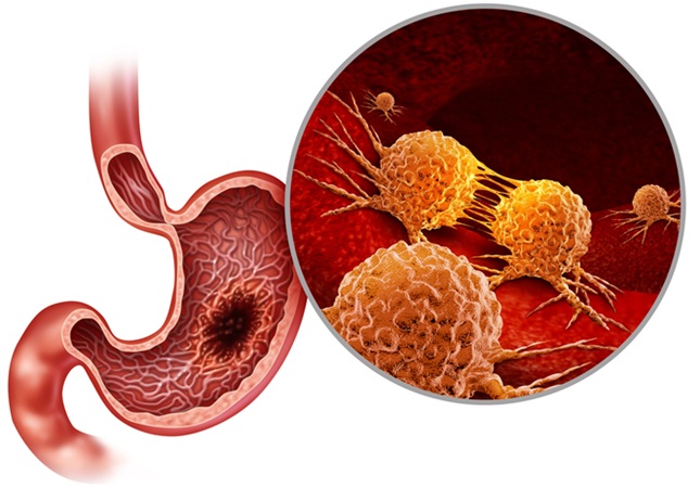 Imagen: los ARN no codificantes CBR3-AS1 y PCA3 se pueden utilizar como objetivos terapéuticos y biomarcadores pronósticos en cáncer gástrico (foto cortesía de Adobe Stock) Imagen: los ARN no codificantes CBR3-AS1 y PCA3 se pueden utilizar como objetivos terapéuticos y biomarcadores pronósticos en cáncer gástrico (foto cortesía de Adobe Stock)