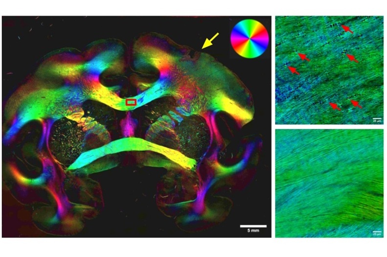 Imagen: la imagen de tres paneles muestra cómo la BRM (microscopía de birrefringencia) mapea la mielina y revela lesiones (flecha amarilla) (fotografía cortesía de AJ Gray et al., Neurophotonics (2025). DOI: 10.1117/1.NPh.12.4.045006)