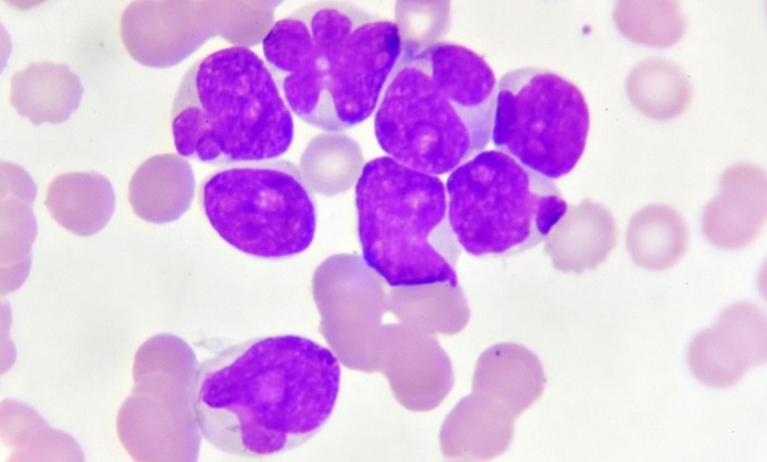 Imagen: las células leucémicas residuales pueden predecir la supervivencia a largo plazo en la leucemia mieloide aguda (fotografía cortesía de Shutterstock)