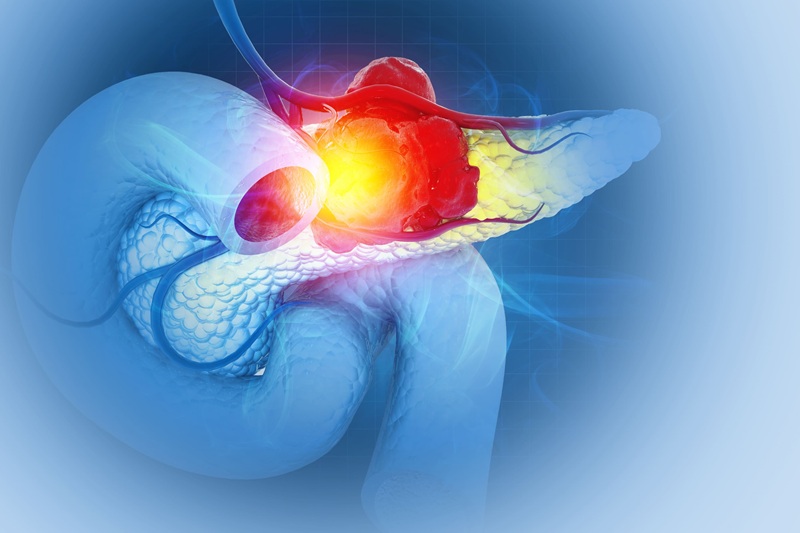 Imagen: el clasificador innovador puede guiar el tratamiento del ACDP y otros cánceres resistentes a la inmunoterapia (fotografía cortesía de Adobe Stock) Imagen: el clasificador innovador puede guiar el tratamiento del ACDP y otros cánceres resistentes a la inmunoterapia (fotografía cortesía de Adobe Stock)