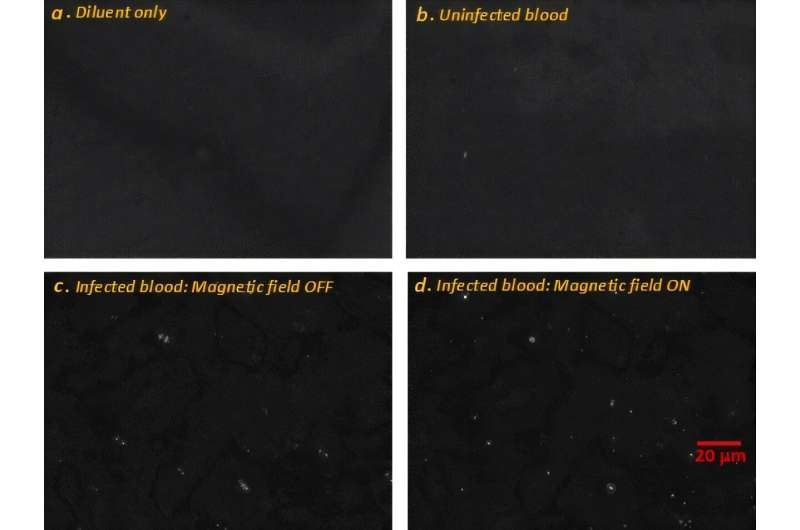 Imagen: Alineación mejorada con campo magnético y detección de hemozoína en glóbulos rojos infectados lisados ​​mediante microscopía de polarización (fotografía cortesía de Dickson Mwenda Kinyua, Universidad de Kirinyaga)