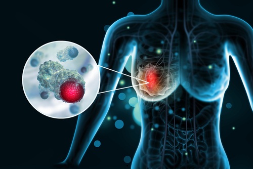 Imagen: Aclarar las características del microambiente tumoral y los programas de células cancerosas vinculados a la respuesta al tratamiento podría proporcionar información más temprana sobre la terapia contra el cáncer de mama triple negativo (crédito de la imagen: Shutterstock)