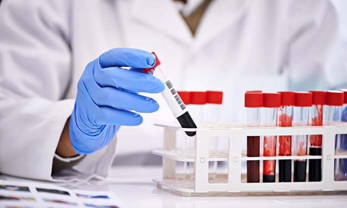 Imagen: Nuevos hallazgos conectan la biología del estrés ribosomal con pequeños biomarcadores de ARN sanguíneos, destacando el potencial de la biopsia líquida para la estratificación de pacientes con cáncer de pulmón (Crédito de la imagen: 123RF) Imagen: Nuevos hallazgos conectan la biología del estrés ribosomal con pequeños biomarcadores de ARN sanguíneos, destacando el potencial de la biopsia líquida para la estratificación de pacientes con cáncer de pulmón (Crédito de la imagen: 123RF)