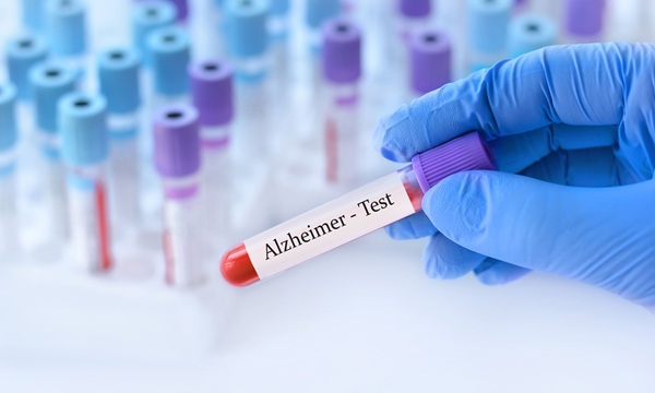 Imagen: El ensayo en sangre analiza la beta amiloide y la tau fosforilada, proteínas cerebrales asociadas con la enfermedad de Alzheimer, para respaldar el diagnóstico clínico (Crédito de la imagen: Adobe Stock) Imagen: El ensayo en sangre analiza la beta amiloide y la tau fosforilada, proteínas cerebrales asociadas con la enfermedad de Alzheimer, para respaldar el diagnóstico clínico (Crédito de la imagen: Adobe Stock)