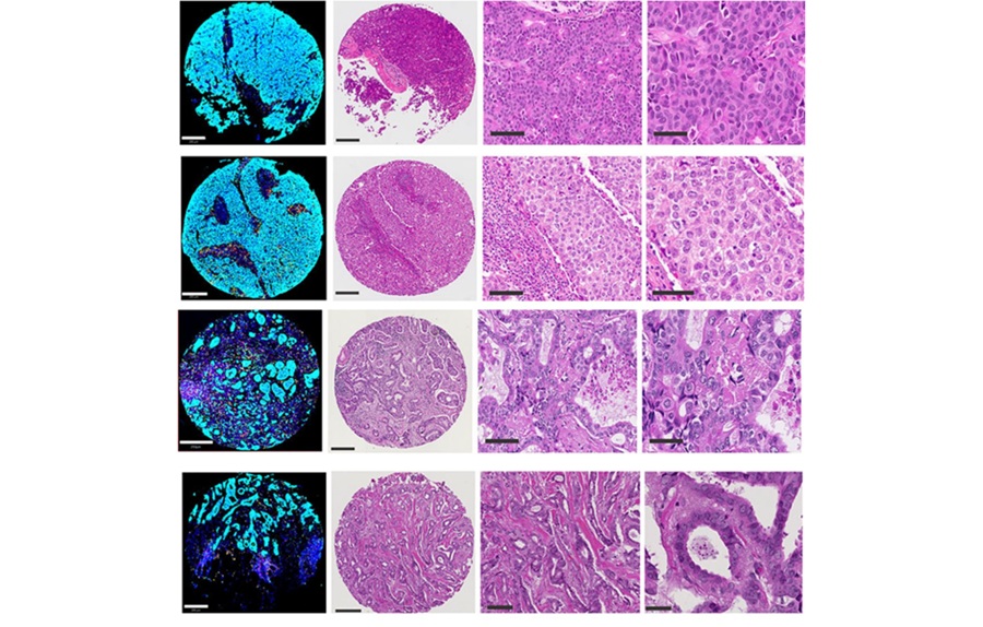 Muestras de tumor mamario analizadas mediante inmunofluorescencia múltiple (izquierda) y tinción de hematoxilina-eosina (derecha) que ilustran puntuaciones de topología basal altas frente a bajas. Las puntuaciones de topología más elevadas reflejan una arquitectura tisular más organizada, mientras que las más bajas indican una mayor desorganización estructural. Al medir cuantitativamente estas diferencias estructurales, los investigadores desarrollaron biomarcadores que predijeron los resultados clínicos de los pacientes con mayor precisión que muchos enfoques tradicionales. (Fotografía cortesía del Columbia University Irving Medical Center)