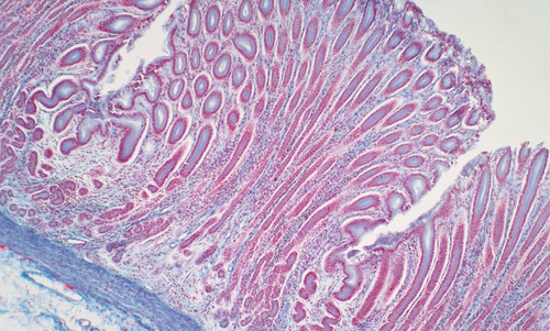 Imagen: La IA analiza la histología digitalizada para identificar regiones tumorales, distinguir las células cancerosas de las sanas y cuantificar la densidad de las células tumorales (Crédito de la imagen: Shutterstock)