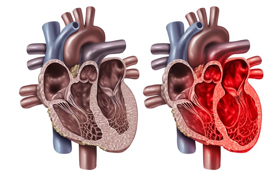 Imagen: El síndrome de Takotsubo es una afección caracterizada por disfunción sistólica aguda transitoria del ventrículo izquierdo y puede ser difícil de distinguir del infarto agudo de miocardio en el momento de la presentación (Crédito de la imagen: Adobe Stock)