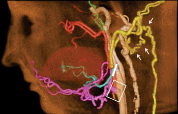 Imagen C: La angiografía TC después del trasplante de cara. La arteria carótida externa del donante (rosa) fue anastomosada exitosamente al vaso del receptor (área rectangular).Las ramas distales a la ligación (línea blanca) recibe el flujo sanguíneo de los vasos contralaterales (flechas) (Fotografía cortesía del RSNA).