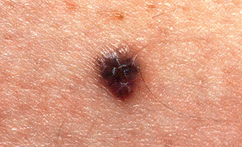 Imagen: Los investigadores han desarrollado un radiofármaco de tomografía computarizada de emisión de fotón simple (SPECT) específico para melanoma maligno (Fotografía cortesía de Wellcome Images). Imagen: Los investigadores han desarrollado un radiofármaco de tomografía computarizada de emisión de fotón simple (SPECT) específico para melanoma maligno (Fotografía cortesía de Wellcome Images).