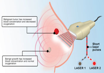 Imagen: El Imagio es un sistema de imagenología optoacústico/ultrasónico bidimensional (2D) de modalidad dual para imagenología diagnóstica del cáncer de mama  (Fotografía cortesía de Seno Medical Instruments).