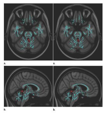 Imagen B: Las alteraciones vestibulares se correlacionan con un aumento de la difusividad media en los lóbulos vermianos del espino-cerebelo, que procesa la entrada de la  propiocepción  de las columnas dorsales de la médula espinal para anticipar el posicionamiento futuro durante el curso de un movimiento. Las imágenes derivadas de los resultados TBSS y visualizadas en las imágenes ponderadas T1 del atlas del Instituto Neurológico Montreal indican que las diferencias significativas de la materia blanca en pacientes con TBI leve y síntomas vestibulares incluyen los lóbulos vermianos II y III, como se muestra en los planes (a) axiales y (b) sagitales. Los voxeles significativos (p  0.05, corregidos para comparaciones múltiples) estaban engrosados usando la función de llenado TBSS en los tractos locales (rojo) y superpuestas en el esqueleto de la materia blanca (azul) (Fotografía cortesía de la revista Radiology).