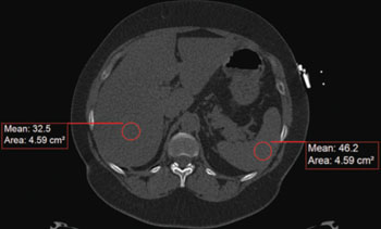 Imagen B: Imagen axial de TC no realzada de un hombre de 62 años de edad que muestra mediciones de atenuación del hígado y el bazo. La imagen muestra una acumulación de grasa difusa en el hígado, con una atenuación hepática media de 32,5 HU y una atenuación media del bazo de 46,2 HU (Fotografía cortesía de la Sociedad Radiológica de Norteamérica / Radiology).