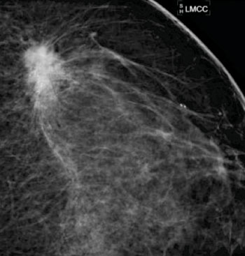 Imagen B: Una visión de aumento puntual demuestra una masa irregular espiculada con calcificaciones asociadas en la porción lateral superior del seno izquierdo.