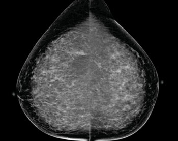 Imagen C: Mamograma de detección demostrando calcificaciones en la porción lateral superior del seno izquierdo. Se muestran las visiones cranio-caudales bilaterales (Fotografía cortesía de la RSNA).