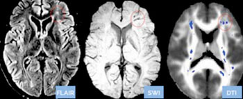 Imagen: Las manchas azules en el examen cerebral con DTI en la derecha, son daño nervioso que no se ve en los otros dos exámenes estándar (recuperación de inversión con atenuación de fluidos [FLAIR] y la imagenología de susceptibilidad ponderada [SWI] del mismo cerebro (Fotografía cortesía de Doctors Imaging).