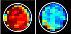 Imagen: Las células normales (izquierda) tienen mucha más azúcar unida a las proteínas de la mucina que las células cancerosas (derecha). El azúcar unido a la mucina genera una alta señal de resonancia magnética, que se muestra en rojo (Fotografía cortesía de Xiaolei Song/Medicina Johns Hopkins).